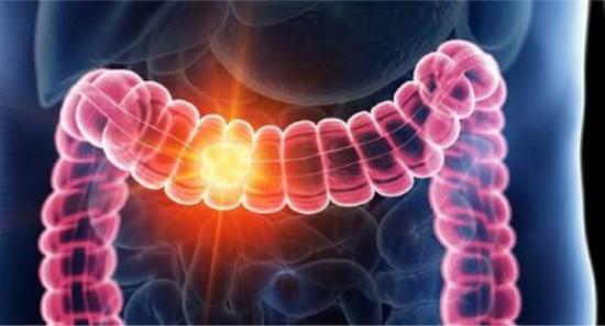 Doctors Alarmed by Rise in Colon and Rectal Cancer